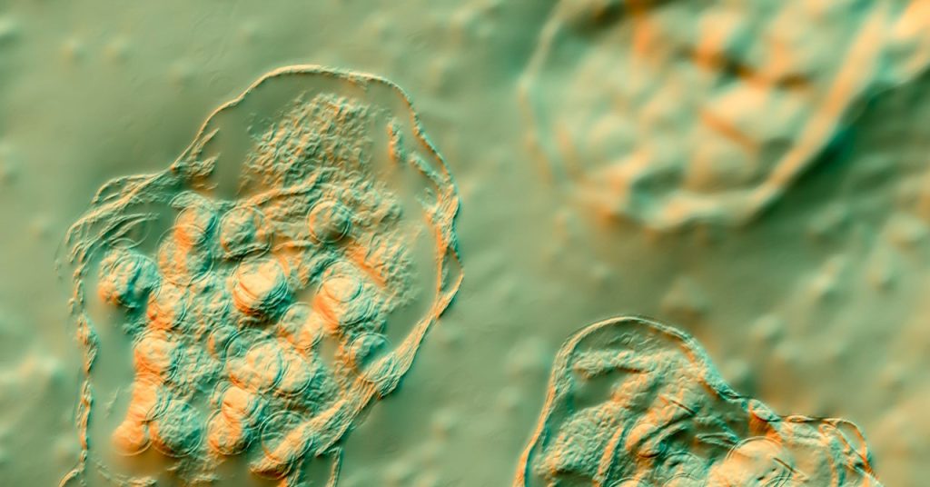 Florida Elementary School Hit by Measles Outbreak: Over 100 Unvaccinated Students Florida Elementary School Hit by Measles Outbreak: Over 100 Unvaccinated Students